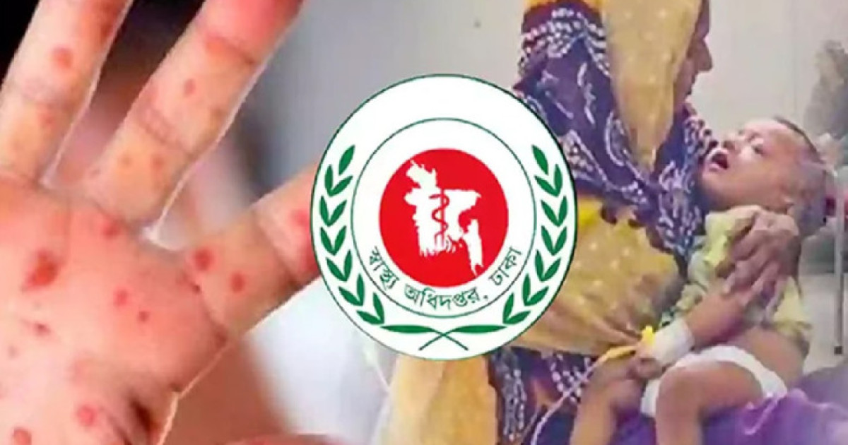 সিলেটে হামের উপসর্গে আরও ৫ শিশুর মৃত্যু, মোট মৃত্যু ৪৭